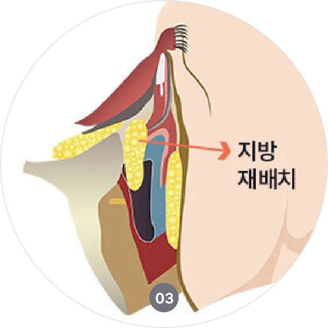 눈밑지방재배치 수술 방법 안내