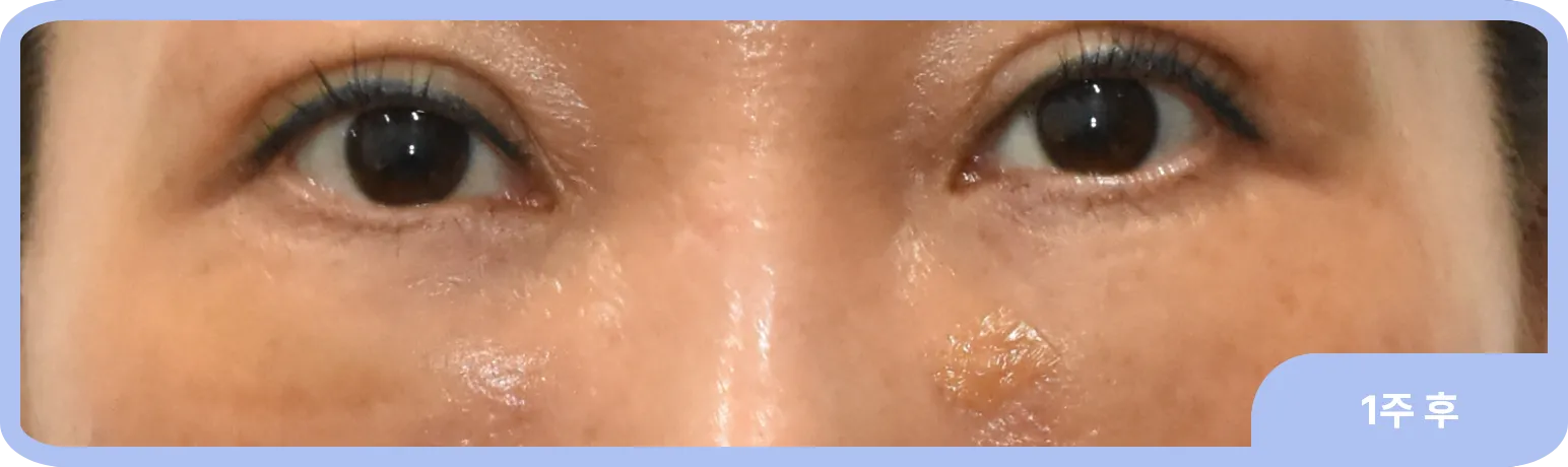 눈물고랑 발달 및 지방 돌출을 교정한 사례 - 눈밑지방재배치 수술 후