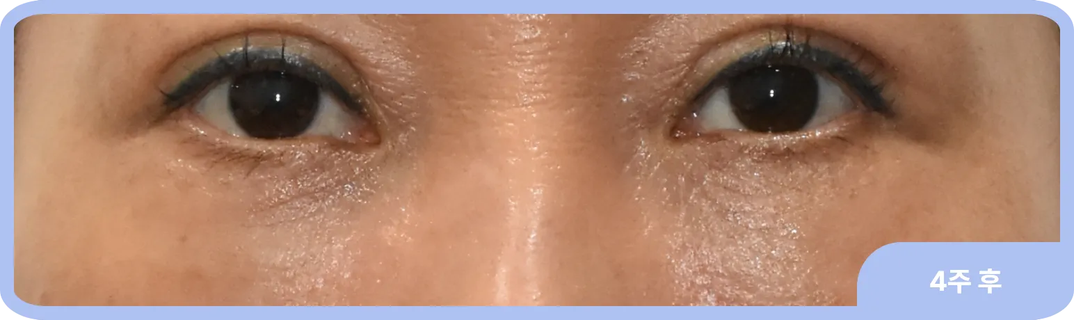 눈밑 지방 재배치 후 자연스럽게 정돈된 눈가 - 눈물고랑을 채워 줄 지방주머니가 충분한 사례