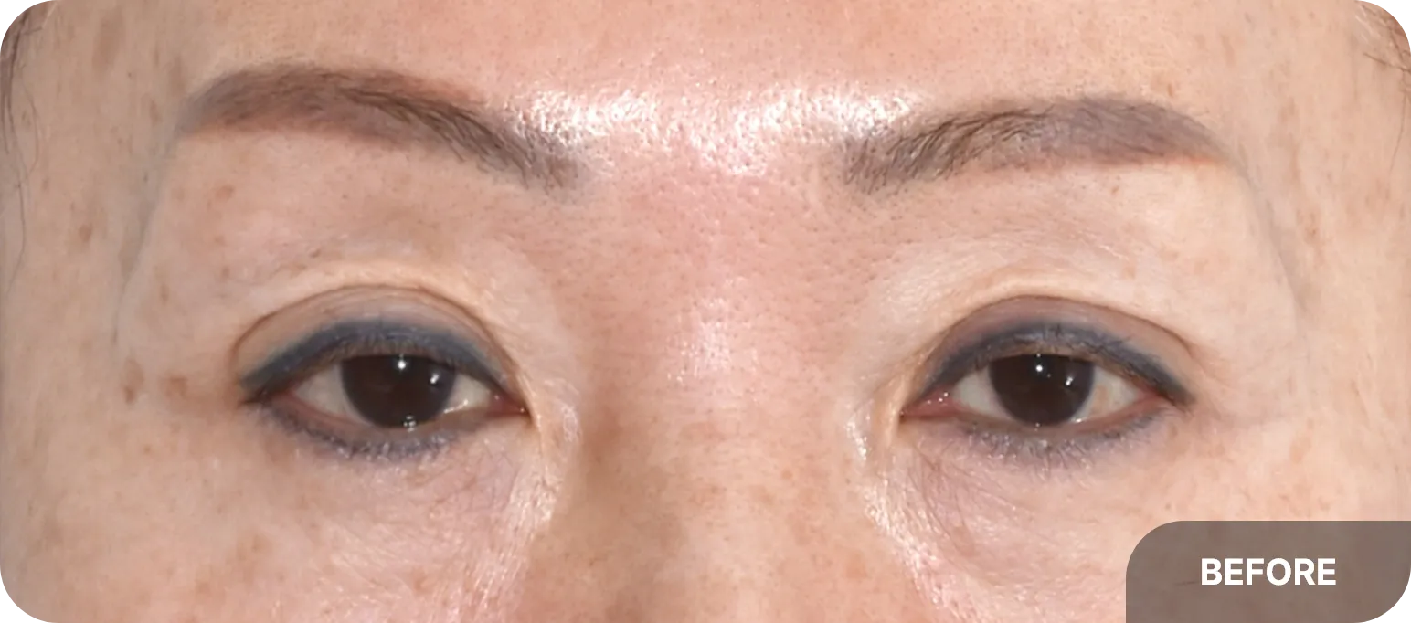 Before eyelid lift surgery - correcting upper eyelid sagging and hollow areas