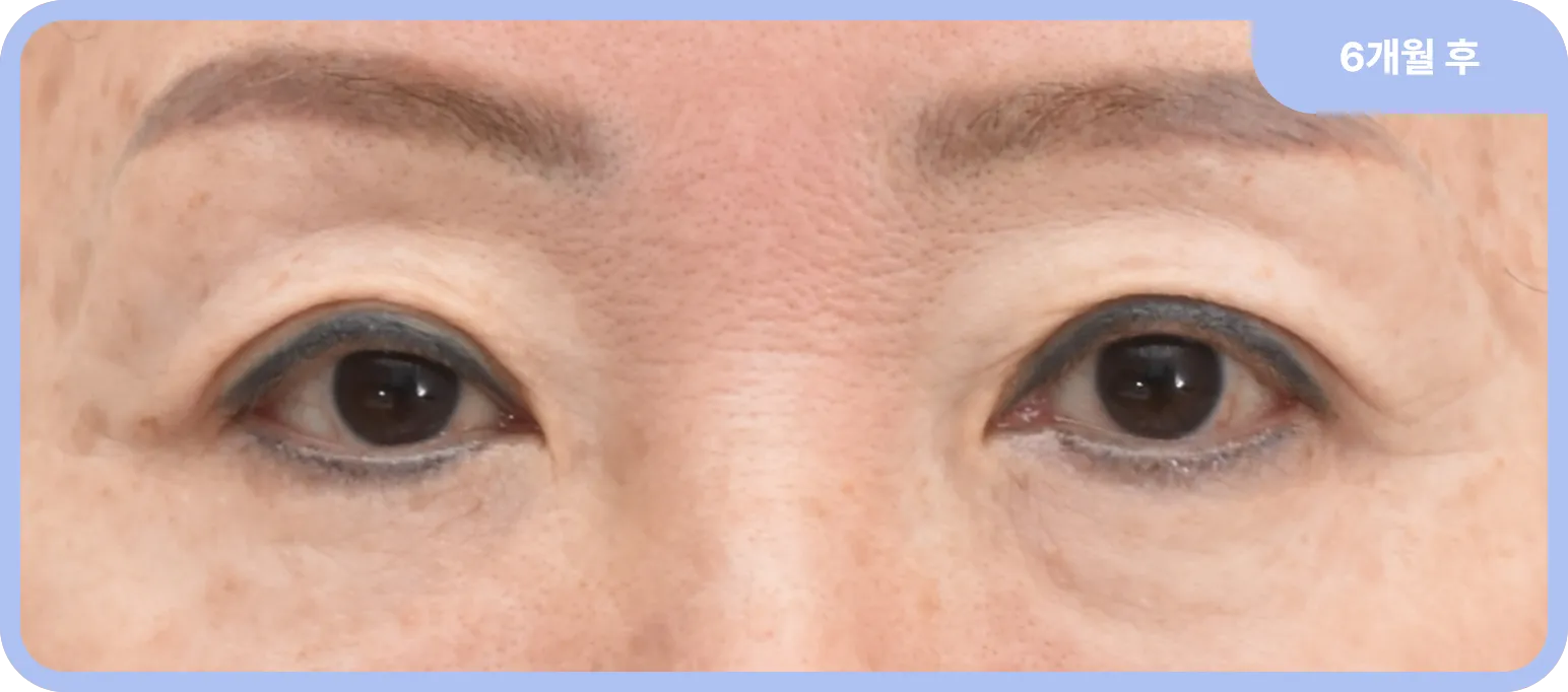 상안검과 눈매교정 수술 후 한층 생기있는 모습