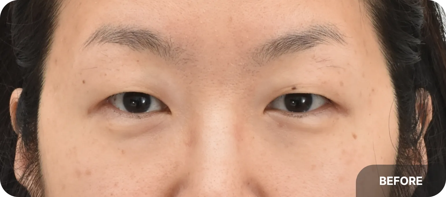 Before upper blepharoplasty - mono eyelid causing sagging and tired appearance