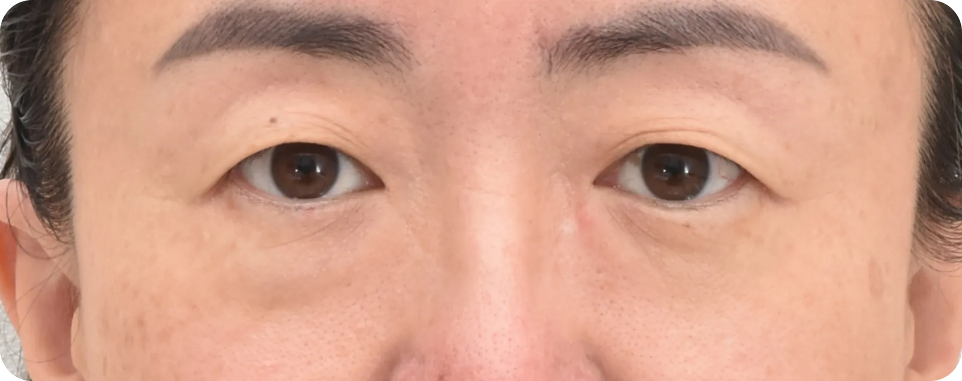 50's women with droopy eyelid - before upper blepharoplasty