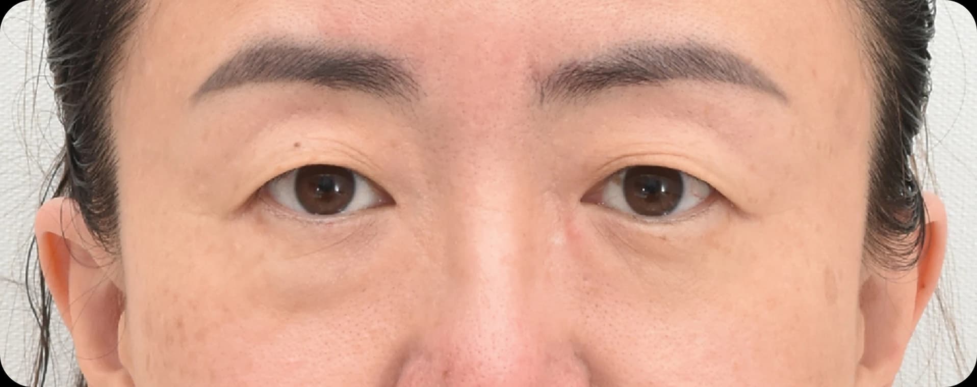 50's women with droopy eyelid - before upper blepharoplasty