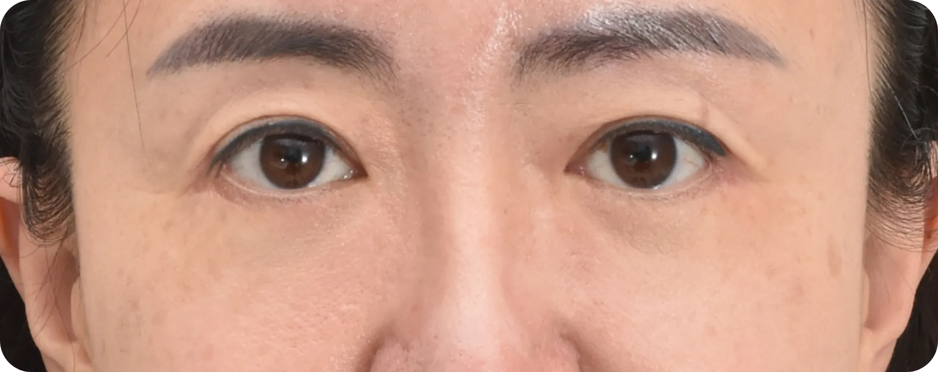 Korean upper blepharoplasty 3 month after - Eyelid rejuvenation and improved eye appearance