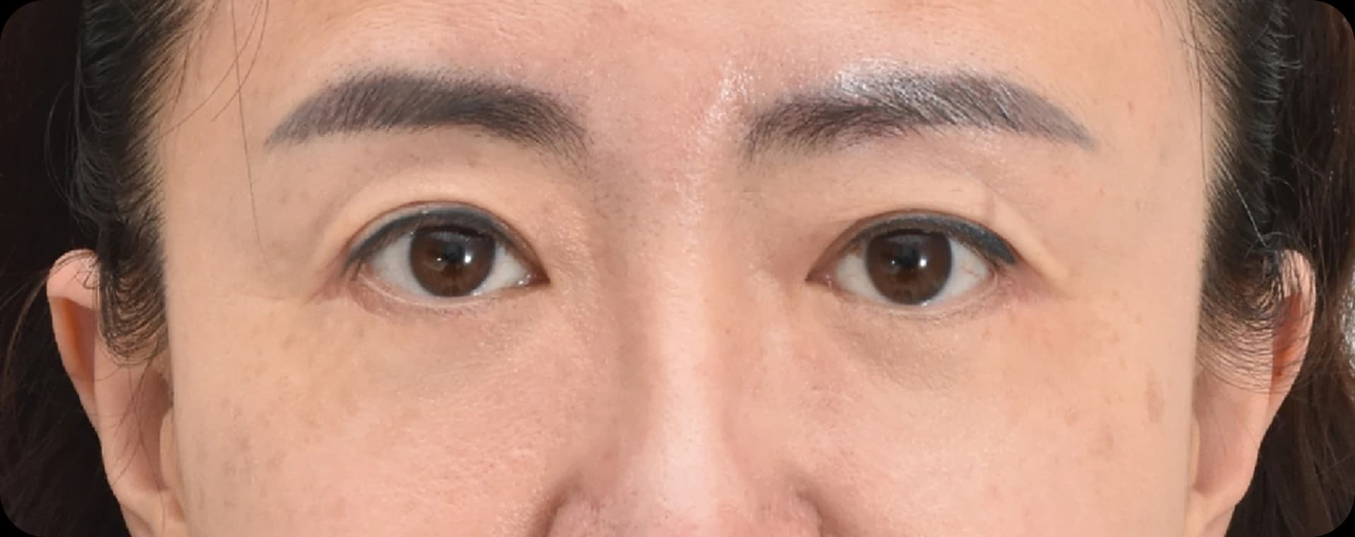 Korean upper blepharoplasty 3 month after - Eyelid rejuvenation and improved eye appearance