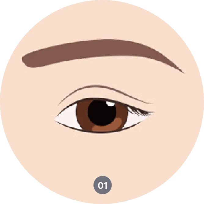 Procedure of upper eyelid surgery in Korea - Correcting droopy eyelids and enhancing eye shape