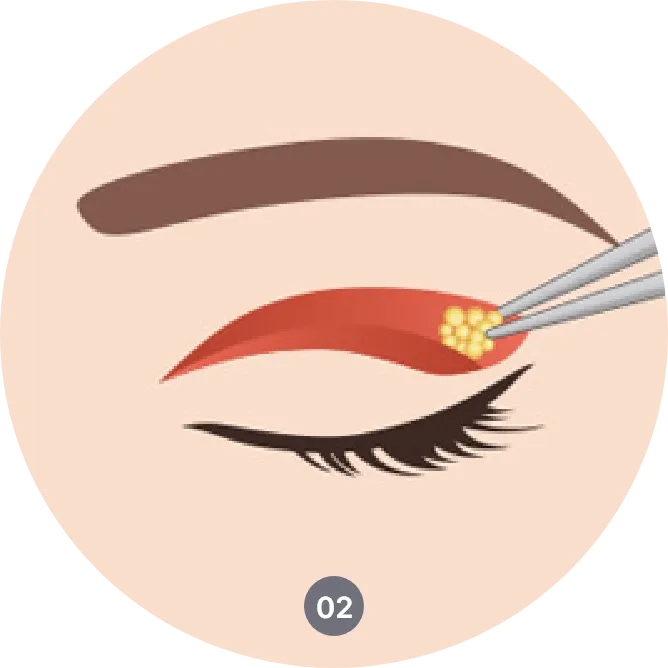 Procedure of upper eyelid surgery in Korea - Correcting droopy eyelids and enhancing eye shape