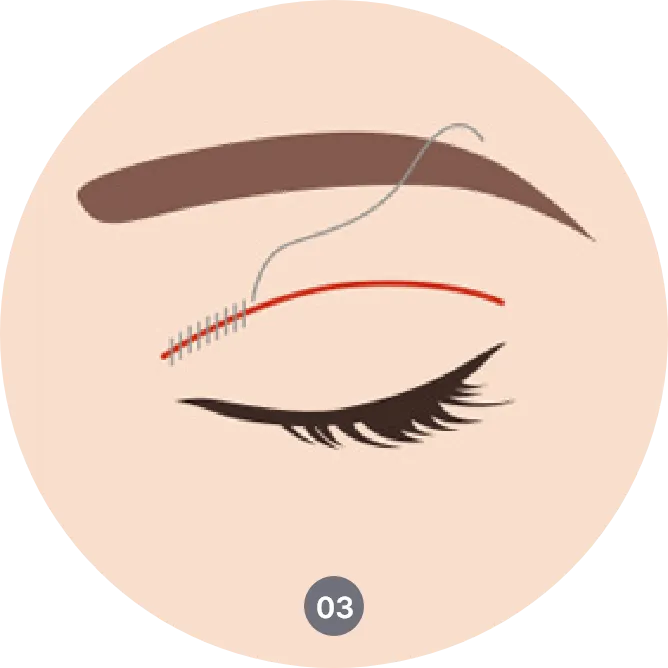 Procedure of upper eyelid surgery in Korea - Correcting droopy eyelids and enhancing eye shape