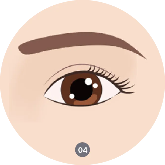 Procedure of upper eyelid surgery in Korea - Correcting droopy eyelids and enhancing eye shape
