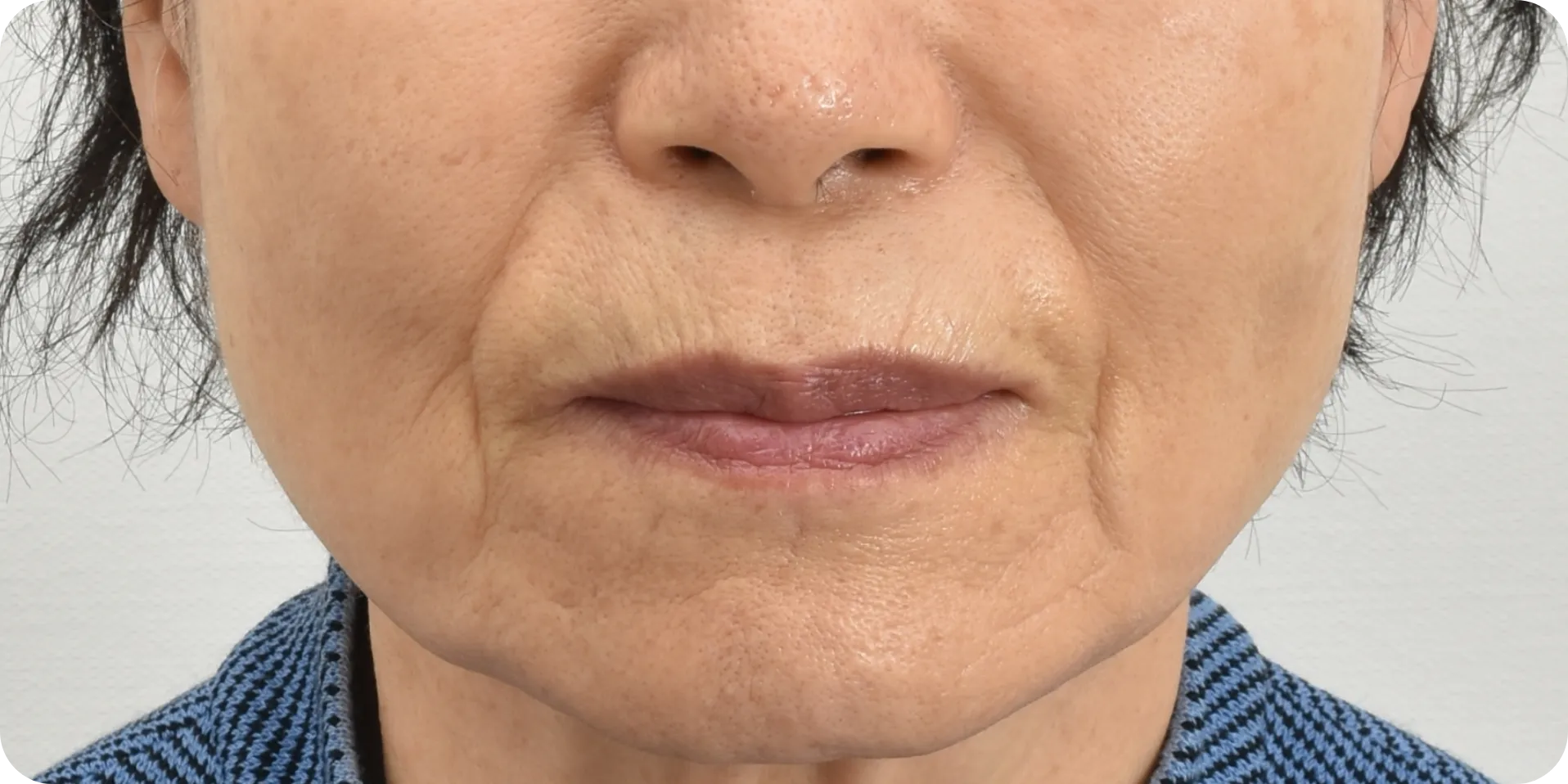 mouth wrinkles laser treatment
