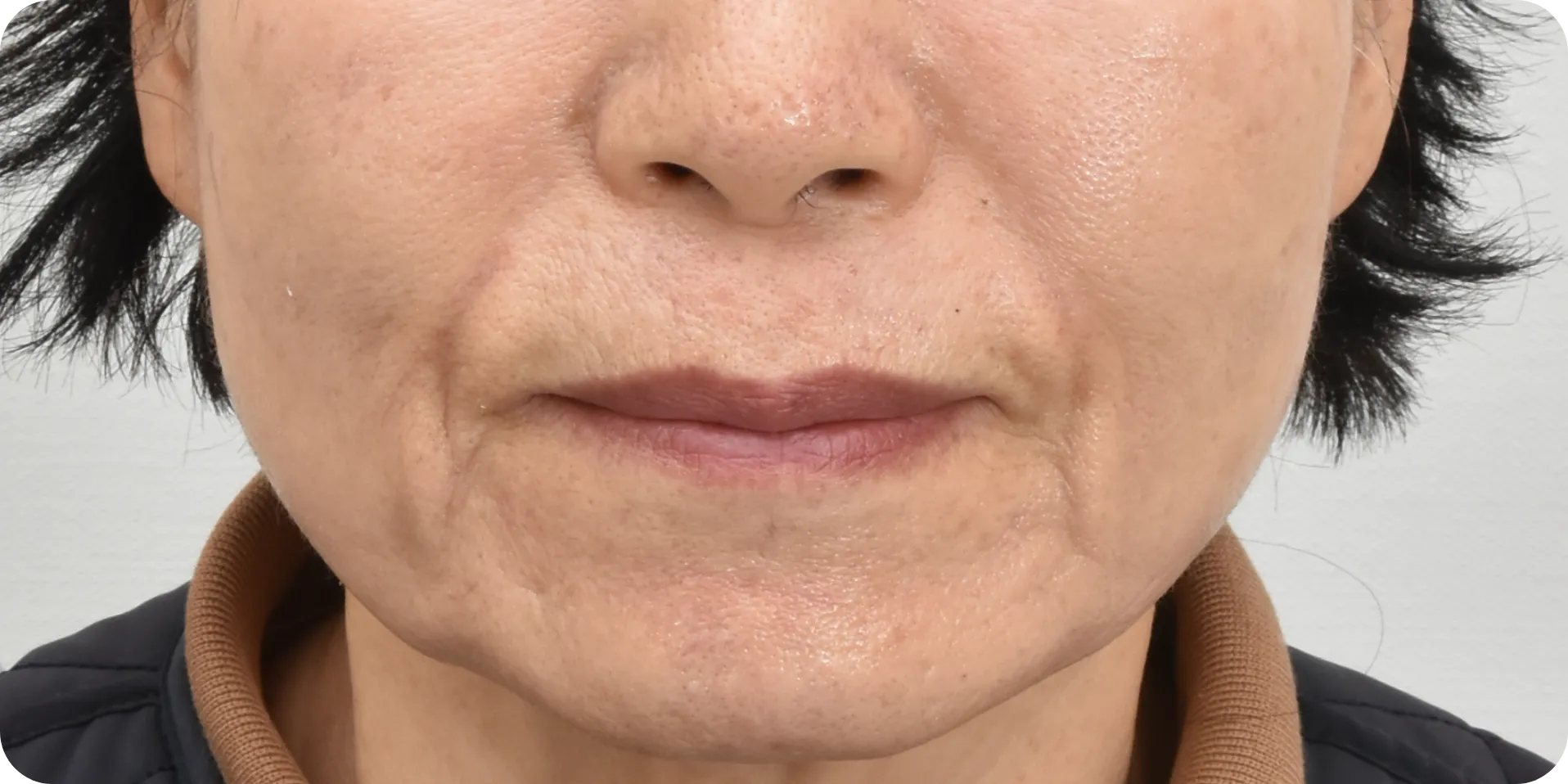 mouth wrinkles laser treatment