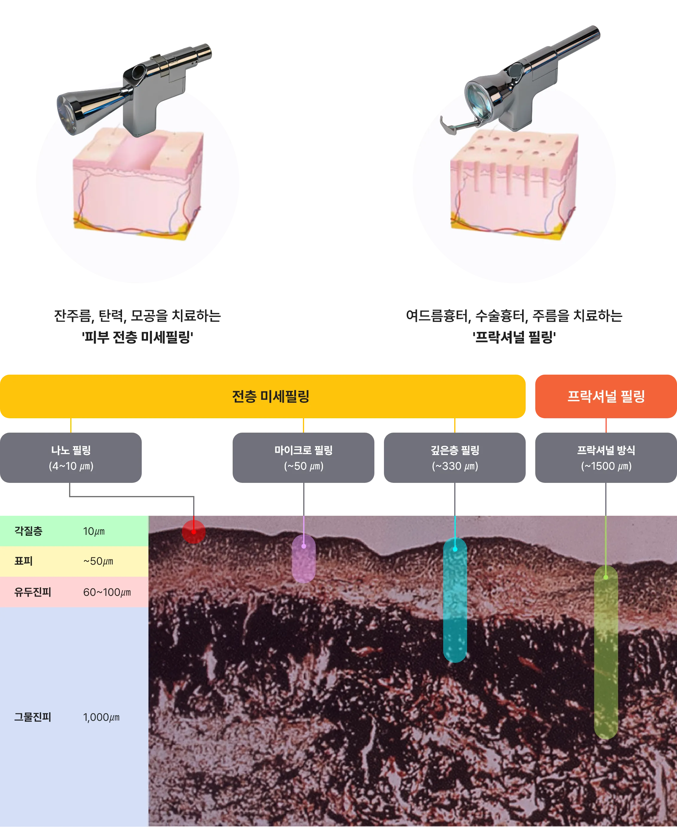 어븀야그 레이저/프락셀레이저