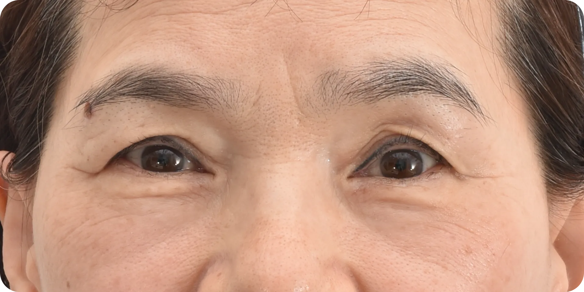 미간주름 치료