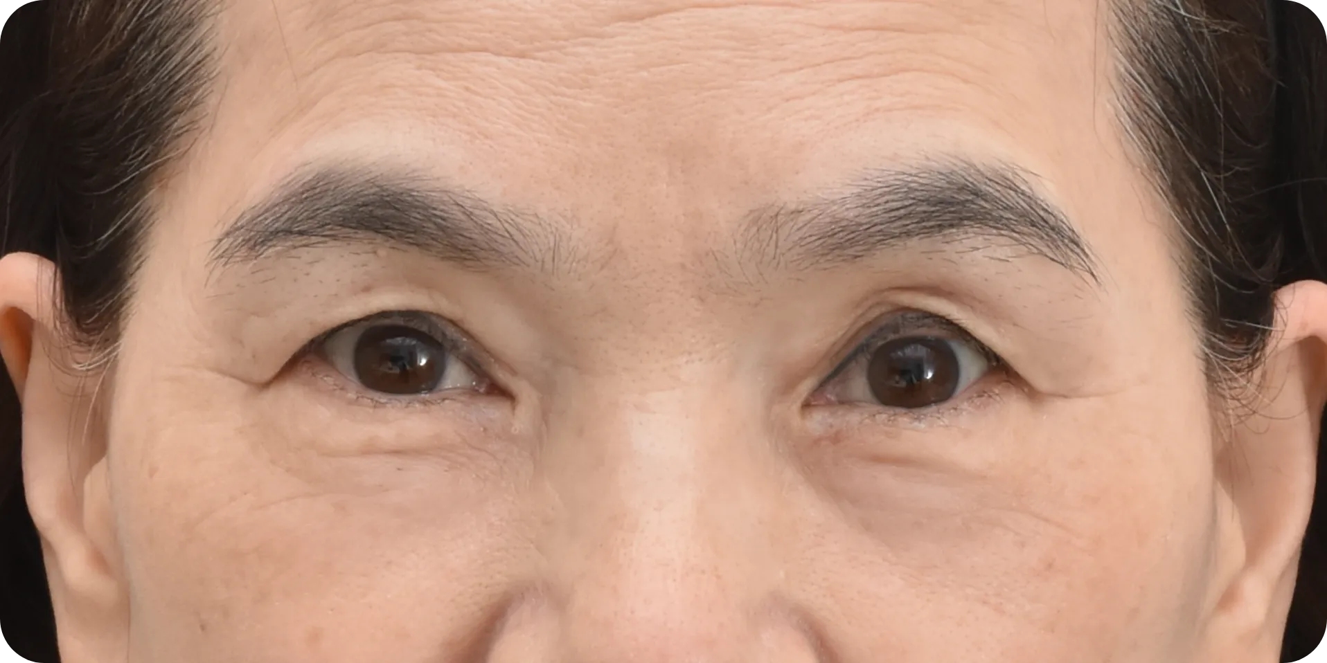 glabellar wrinkles surgery - after