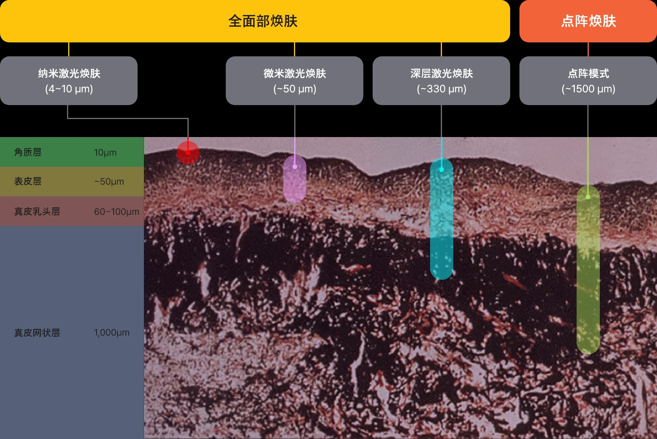 Sciton ZoomScan - full face facial resurfacing treatment/Sciton Profractional - fractional resurfacing laser/laser peeling with Sciton
