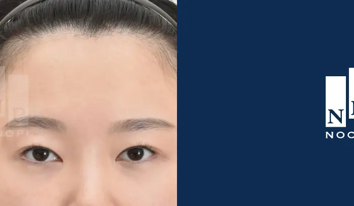 쌍꺼풀 눈매교정 뒤밑트임