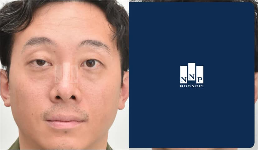 Ptosis surgery, Lower bleph