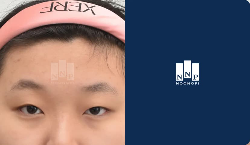 쌍꺼풀 눈매교정, 앞트임