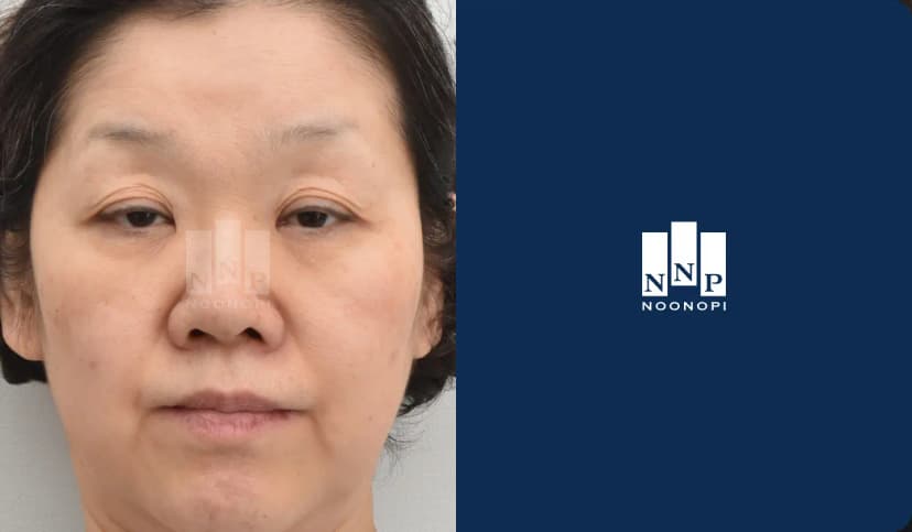 상안검 눈매교정