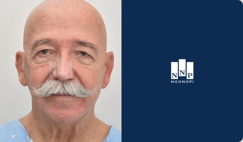 미니거상, 목거상, 하안검, 눈썹상거상