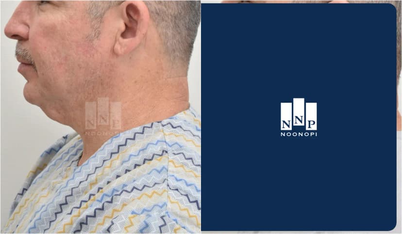 Mini incision neck lift