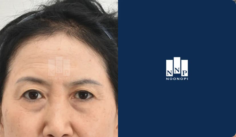 이마거상, 하안검, 지방이식 장기결과