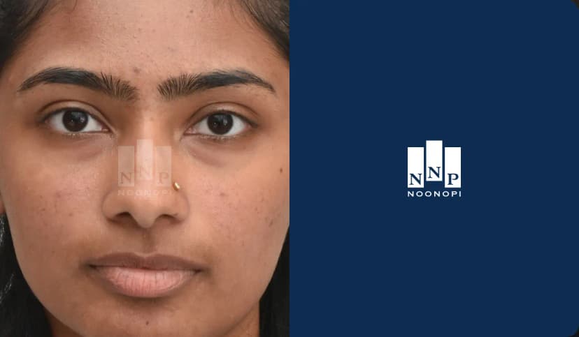 눈밑지방재배치