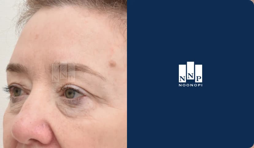 레이저 주름제거술