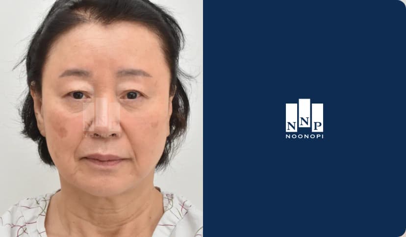 안면거상, 하안검, 지방이식, 피부박피술