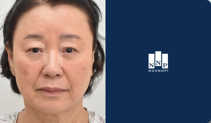 안면거상, 하안검, 지방이식, 피부박피술