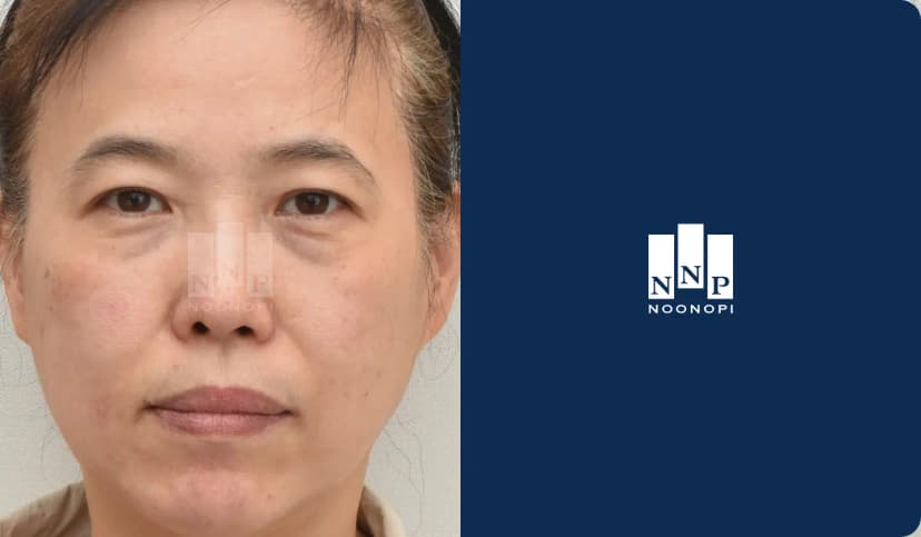 Scarless lower bleph