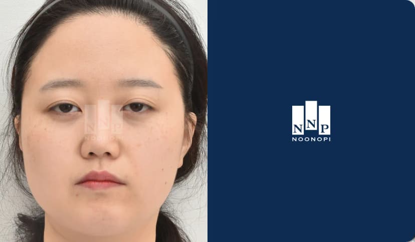 Double eyelid with ptosis correction, epicanthoplasty